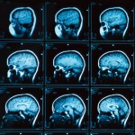 diseases that affect memory loss